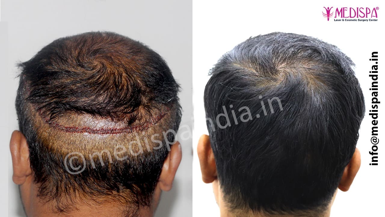 wrong hair transplant repair in india