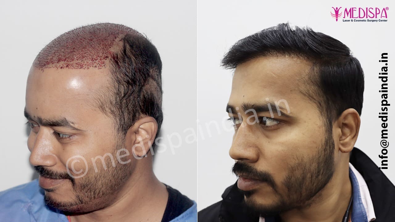 wrong hair transplant repair in delhi, india