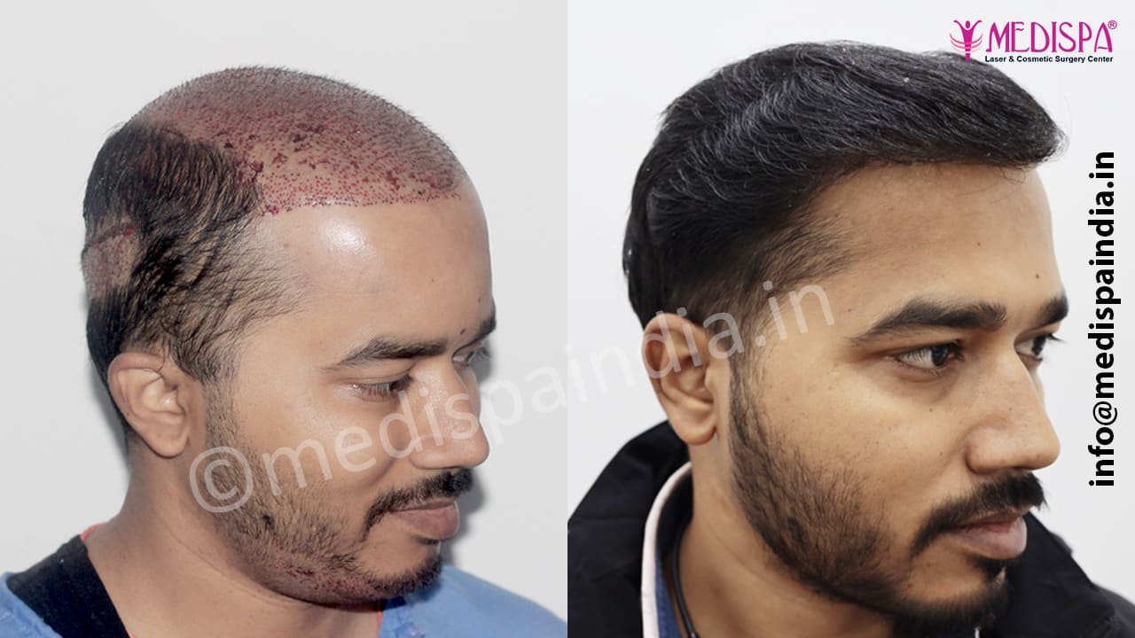 wrong hair transplant repair in india