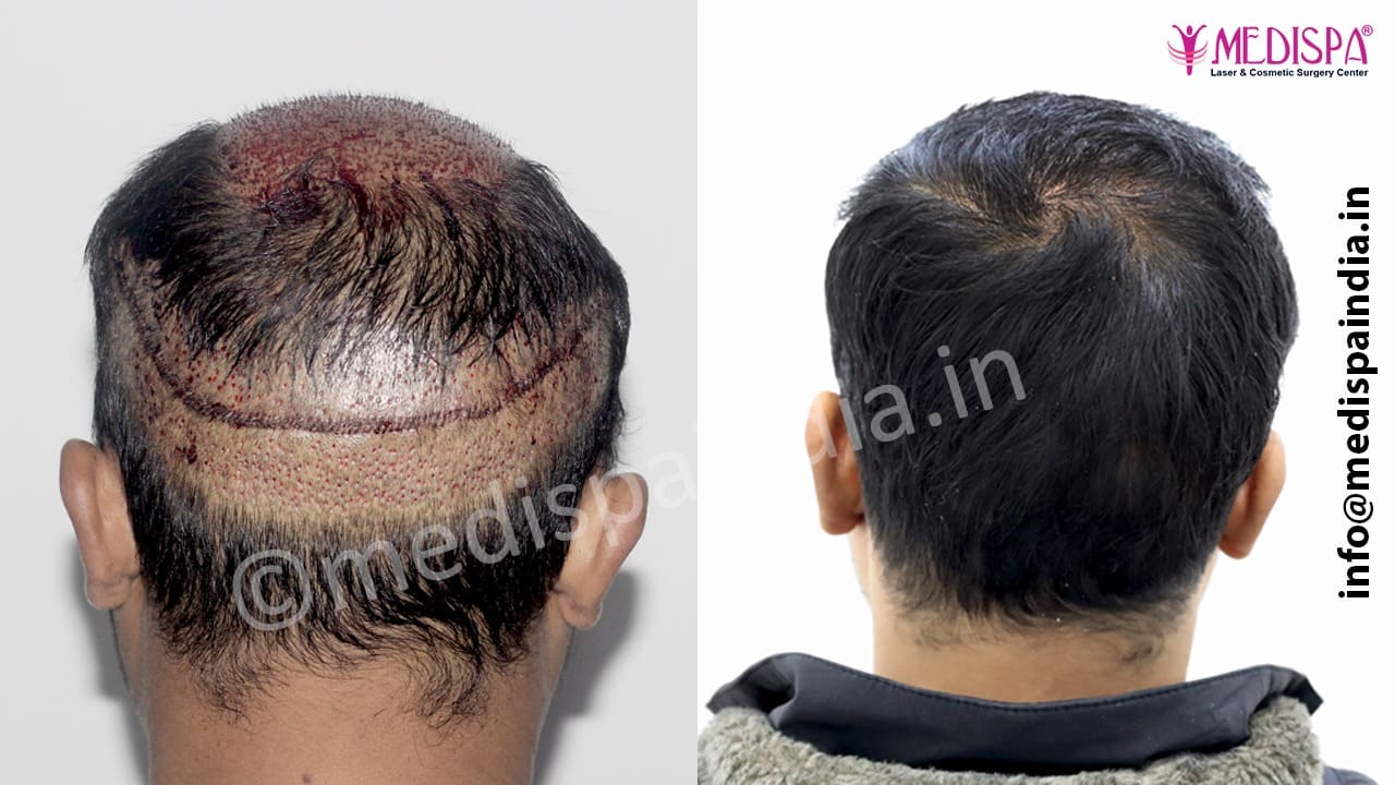 wrong hair transplant repair in jaipur, india