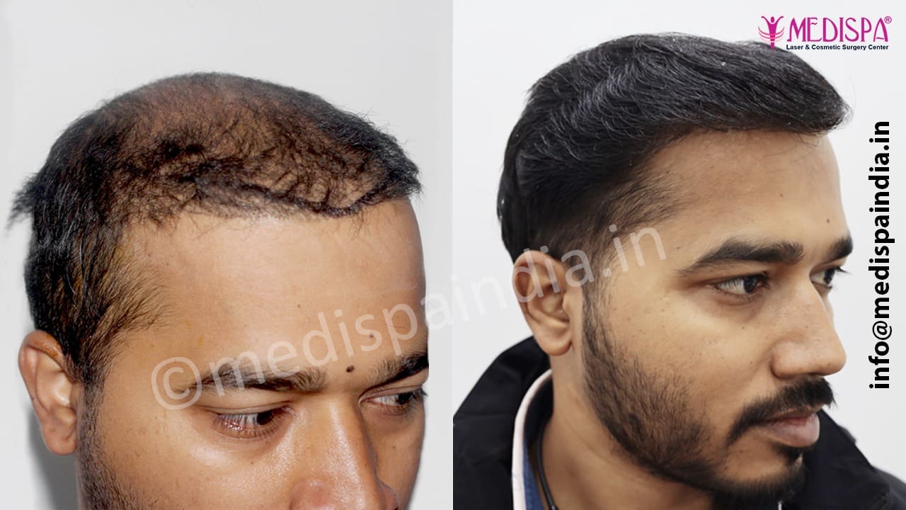 wrong hair transplant repair in jaipur