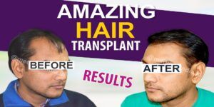 Important Points To Consider Before Undergoing Hair Transplant