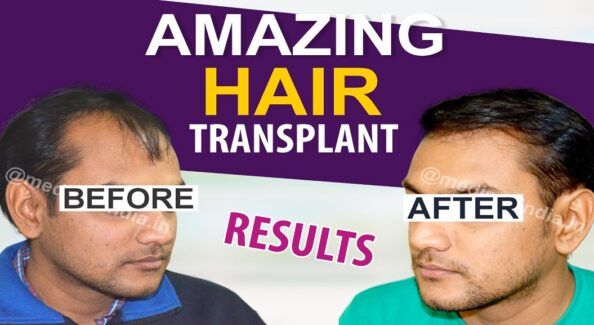 Important Points To Consider Before Undergoing Hair Transplant
