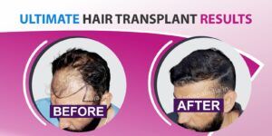 How To Identify A Reputable Hair Transplant Doctor?