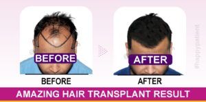 Is Hair Transplant in India Economical Than Other Countries?