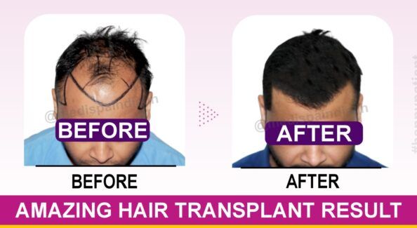 Is Hair Transplant in India Economical Than Other Countries?