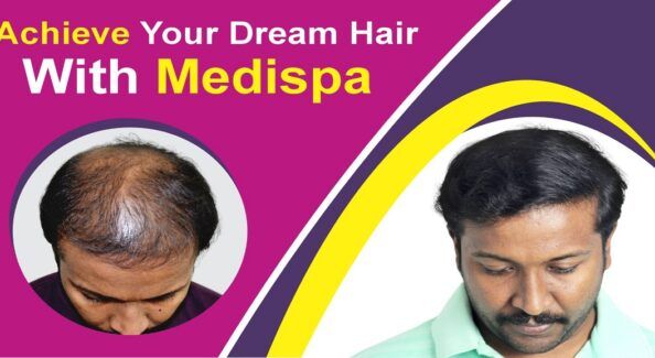 The Ultimate Solution To Baldness: Hair Transplant Surgery