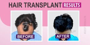 How To Improve The Success Rate of Hair Transplant Surgery?