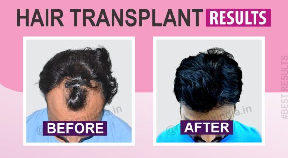 How To Improve The Success Rate of Hair Transplant Surgery?