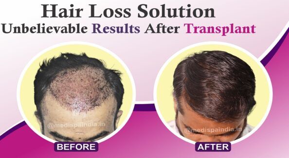 When Should You Consider Getting Second Hair Transplant?