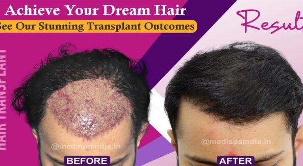 Can Hair Transplant Produce Long Lasting Results?
