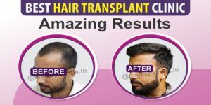 Important Things To Know Before Undergoing Hair Transplant