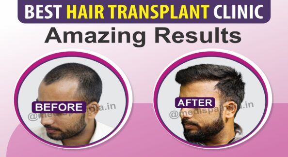 Important Things To Know Before Undergoing Hair Transplant