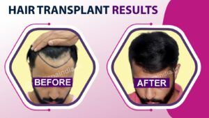 Hair Transplant Success Rate: Understanding The Factors That Affect The Results