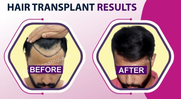Hair Transplant Success Rate: Understanding The Factors That Affect The Results
