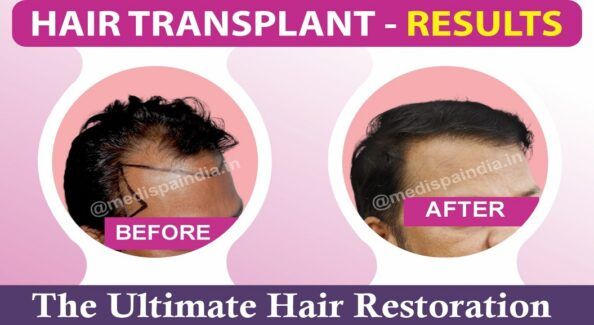 Ultimate Guide To Select The Best Hair Transplant Clinic