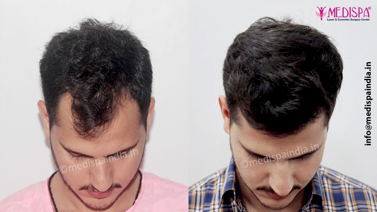 fue hair transplant doctor