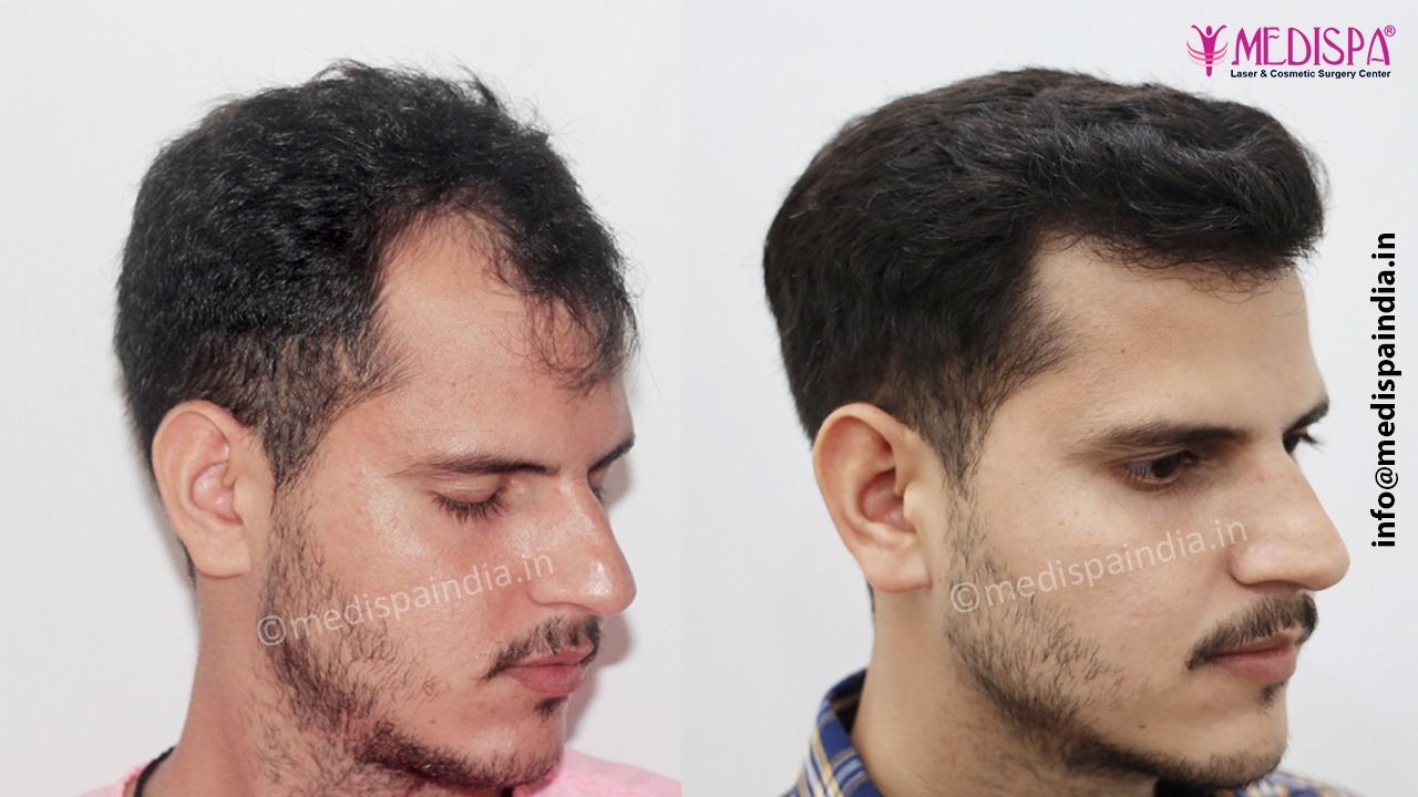 fue hair transplant price