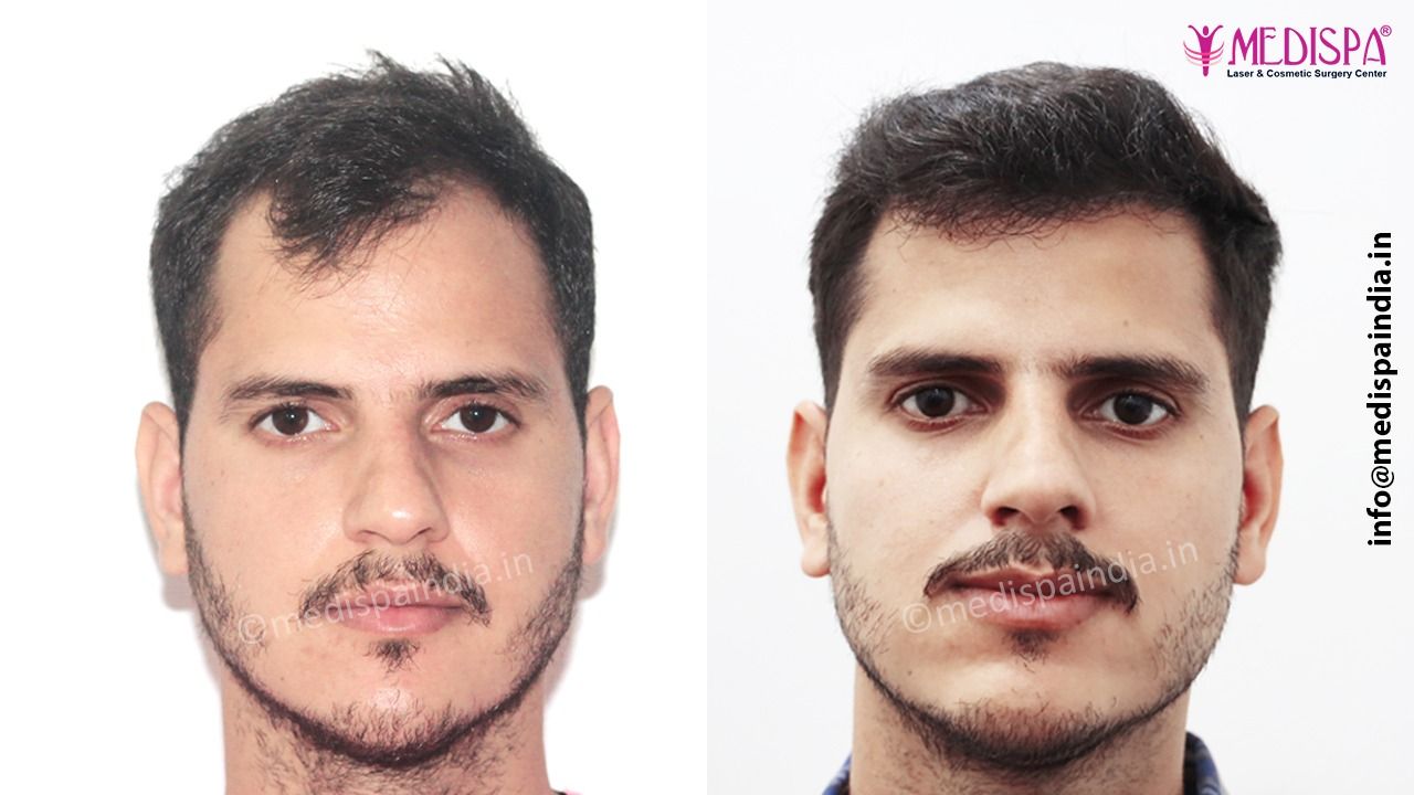 fue hair transplant