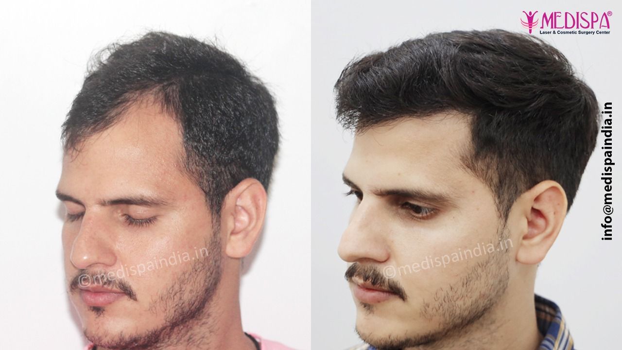 fue hair transplants