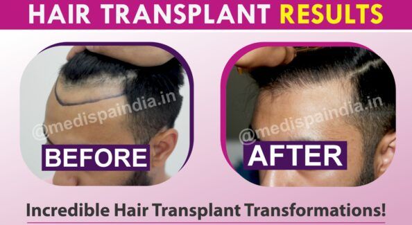 Is It Possible To Get Hair Transplantation Without Scars?