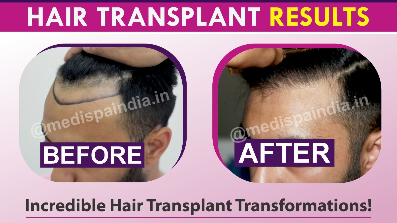 Is It Possible To Get Hair Transplantation Without Scars?