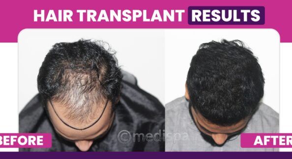 How Can Hair Transplant Help in Achieving Perfect Hairline With Enhanced Density