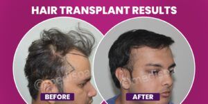 What Are The Hair Transplant Options For Men And Women?