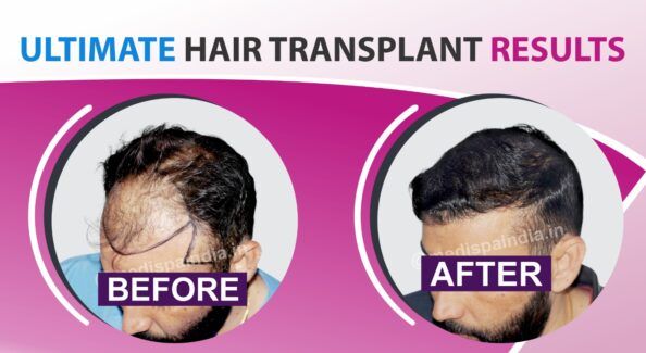 Why Should You Consider Hair Restoration For Hair Loss Issue? Explain!