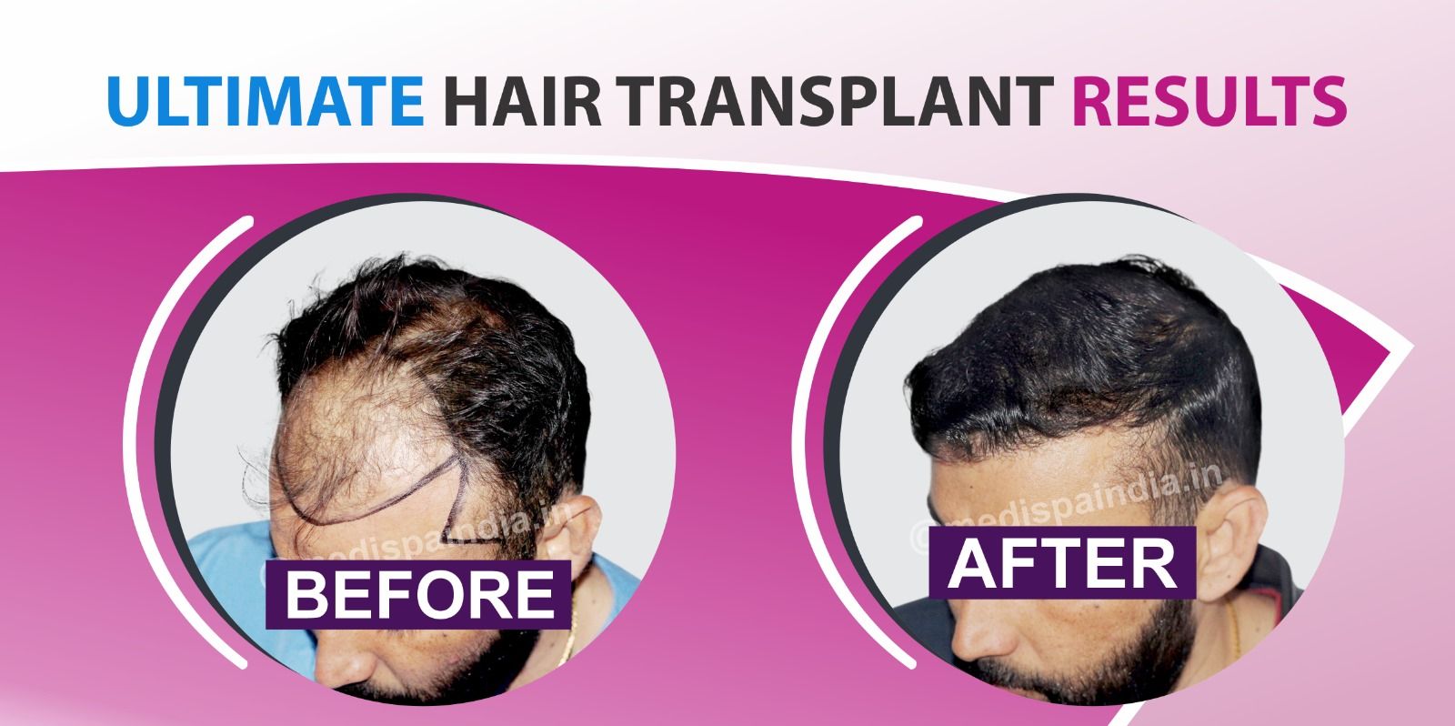 Why Should You Consider Hair Restoration For Hair Loss Issue? Explain!