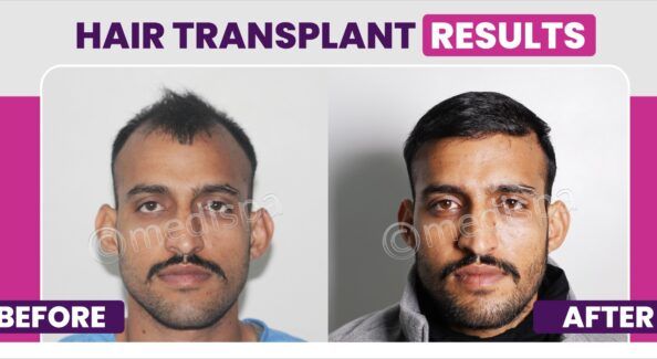 How Much Time Does It Take For The Transplanted Hair To Grow?