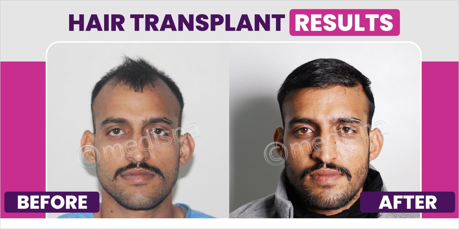 How Much Time Does It Take For The Transplanted Hair To Grow?