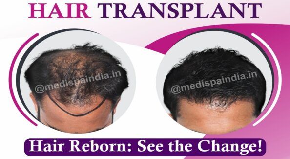 Hair Transplant Effectiveness: What You Need To Know Before Considering The Procedure