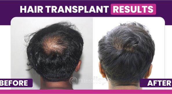 How To Improve The Hair Transplantation Success Ratio?