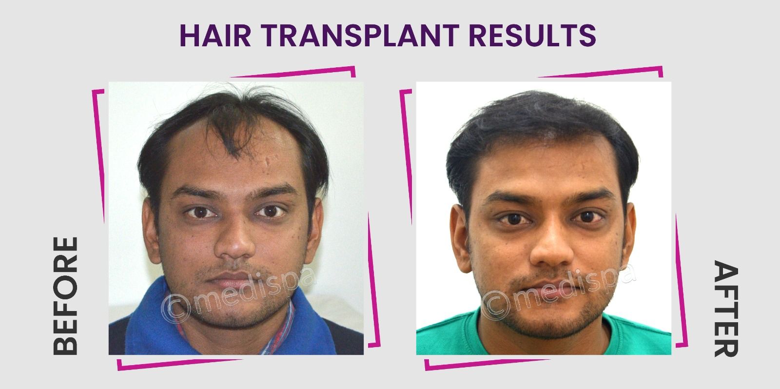 Explain the Entire Working Process of Hair Transplant