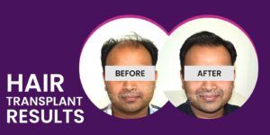 Hair Restoration: What You Need To Know Before You Go Under The Knife