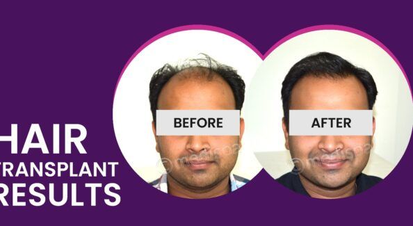 Hair Restoration: What You Need To Know Before You Go Under The Knife