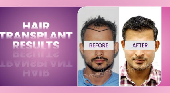 Is Hair Restoration Suitable For You? Points To Consider Before Making The Decision