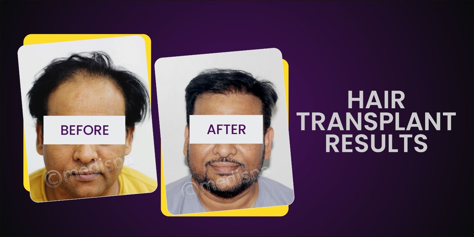 How To Know About The Most Appropriate Technique For Hair Restoration?