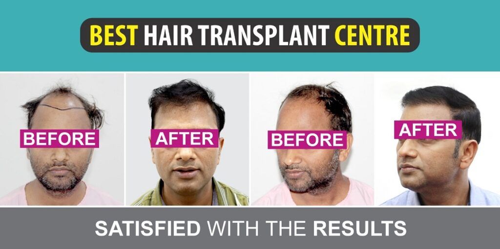 An Essential Guide To Female Hair Transplant