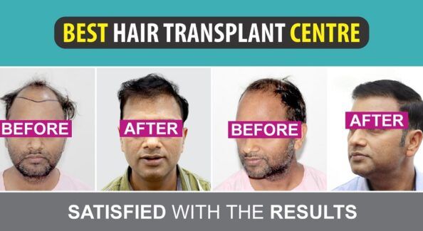 Is It Possible To Get Cost-Effective Hair Transplant With Best Results?