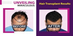 What Is The Ideal Time To Undergo Hair Transplant Surgery?