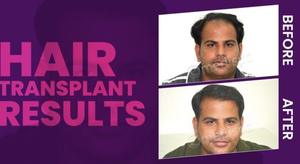 Unlock Your Hair's Potential: Get Expert Hair Transplant Treatment