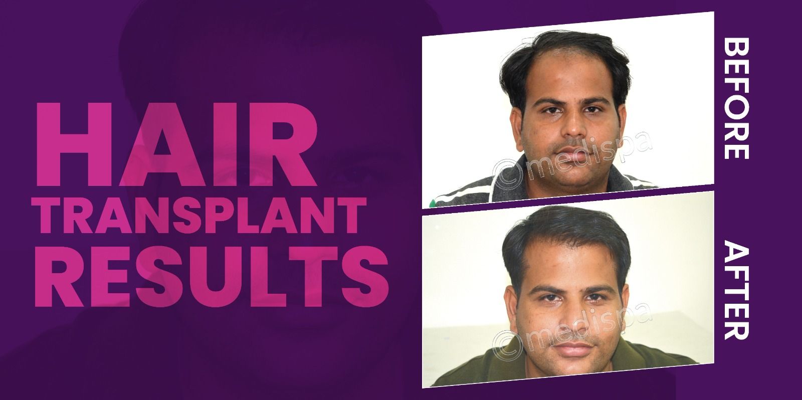Unlock Your Hair's Potential: Get Expert Hair Transplant Treatment