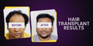 Explain All The Vital Factors That Affect Hair Transplant Cost