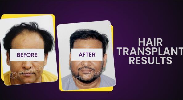 Explain All The Vital Factors That Affect Hair Transplant Cost