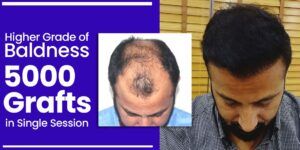 Why is FUT+FUE+BHT Hair Transplant Better Technique Than Other Methods?