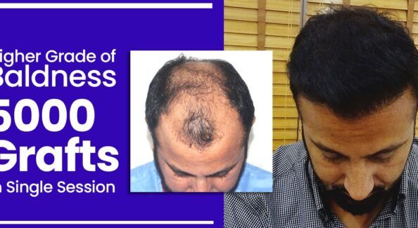 Why is FUT+FUE+BHT Hair Transplant Better Technique Than Other Methods?