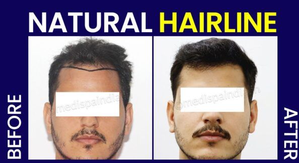 Hair Transplant Recovery: Tips And Tricks For A Smooth Healing Process