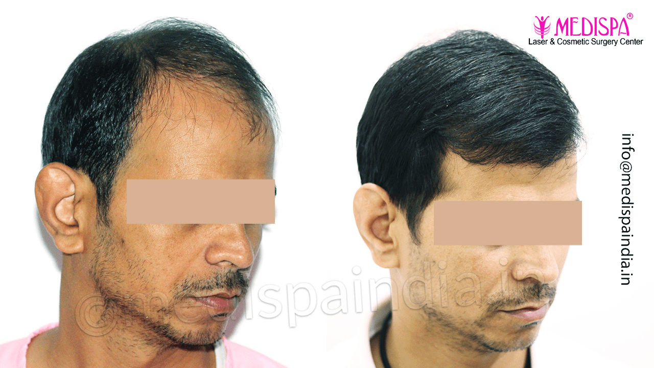 best hair transplant surgeon bangalore